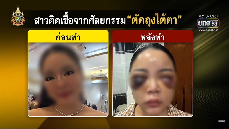 ศัลยกรรมถุงใต้ตา