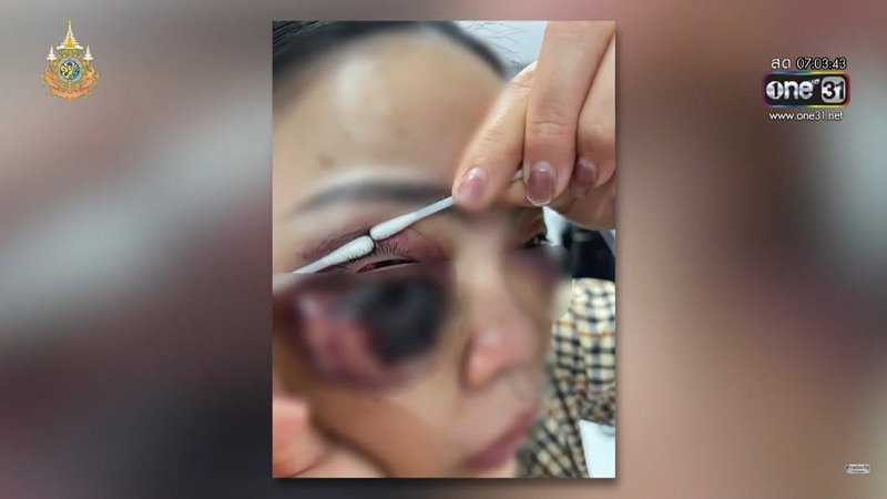 ศัลยกรรมถุงใต้ตา