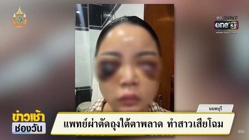 ศัลยกรรมถุงใต้ตา