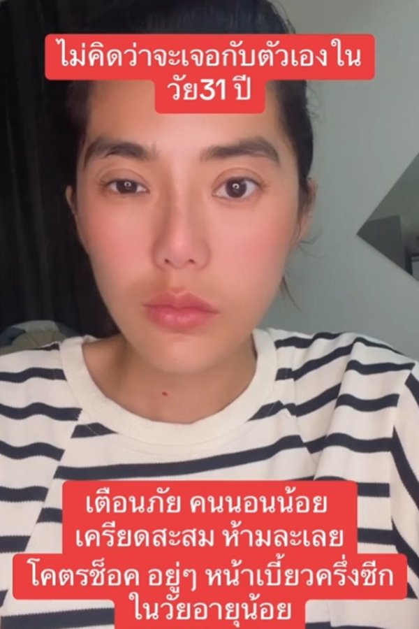 โรคหน้าเบี้ยวครึ่งซีก