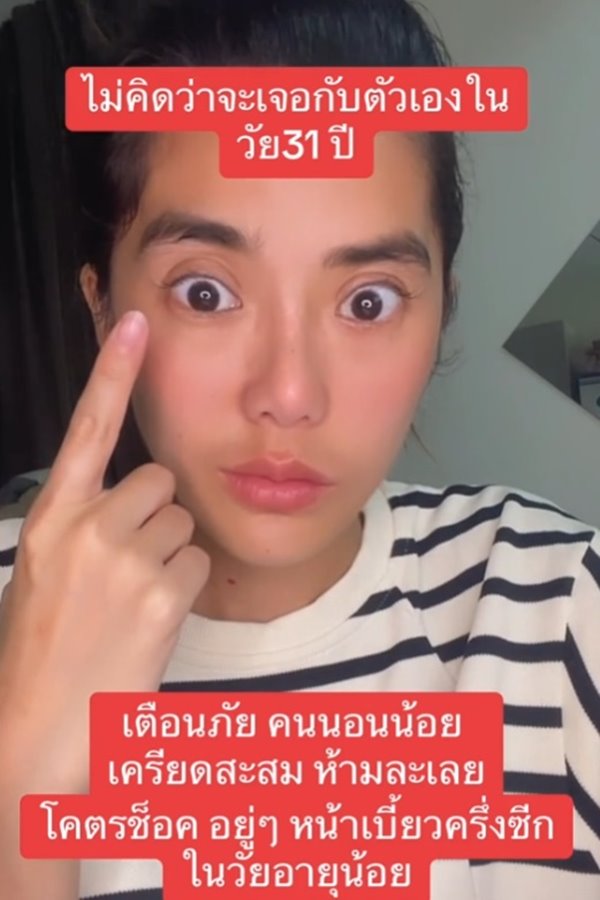 โรคหน้าเบี้ยวครึ่งซีก