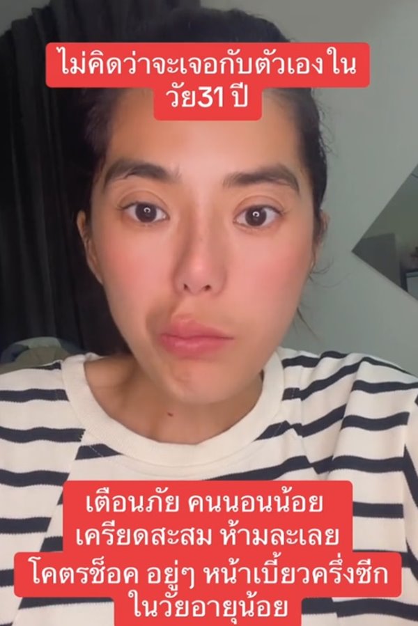 โรคหน้าเบี้ยวครึ่งซีก