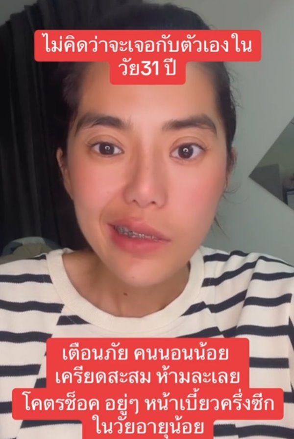โรคหน้าเบี้ยวครึ่งซีก