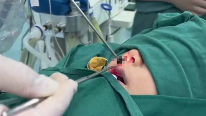 เด็กชาย 7 ขวบ ได้กลิ่นเหม็นปริศนา ผ่านไป 2 ปีถึงรู้ มีสิ่งแปลกปลอมในจมูก