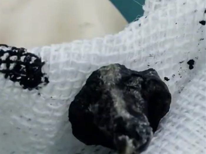 เด็กชาย 7 ขวบ ได้กลิ่นเหม็นปริศนา ผ่านไป 2 ปีถึงรู้ มีสิ่งแปลกปลอมในจมูก