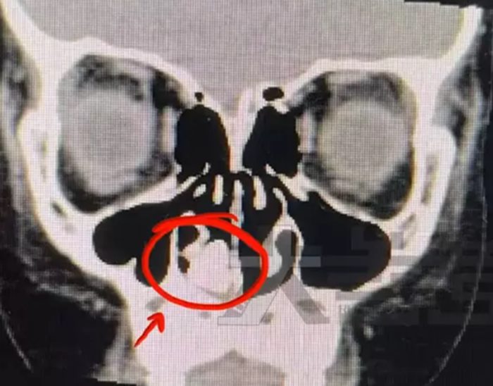 เด็กชาย 7 ขวบ ได้กลิ่นเหม็นปริศนา ผ่านไป 2 ปีถึงรู้ มีสิ่งแปลกปลอมในจมูก