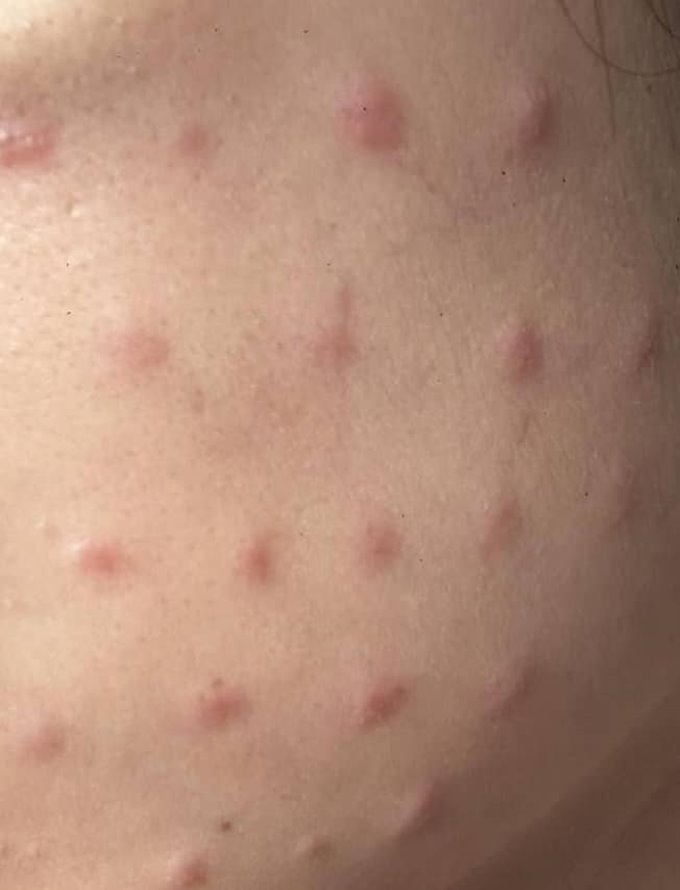 ฉีดเมโสเสร็จ ตุ่มขึ้นหน้า ก่อนรู้สาเหตุหมอเอาอะไรฉีด