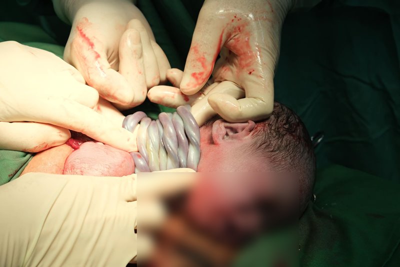 เคสหายาก ผ่าคลอดทารกมีสายสะดือพันรอบคอ 9 รอบ