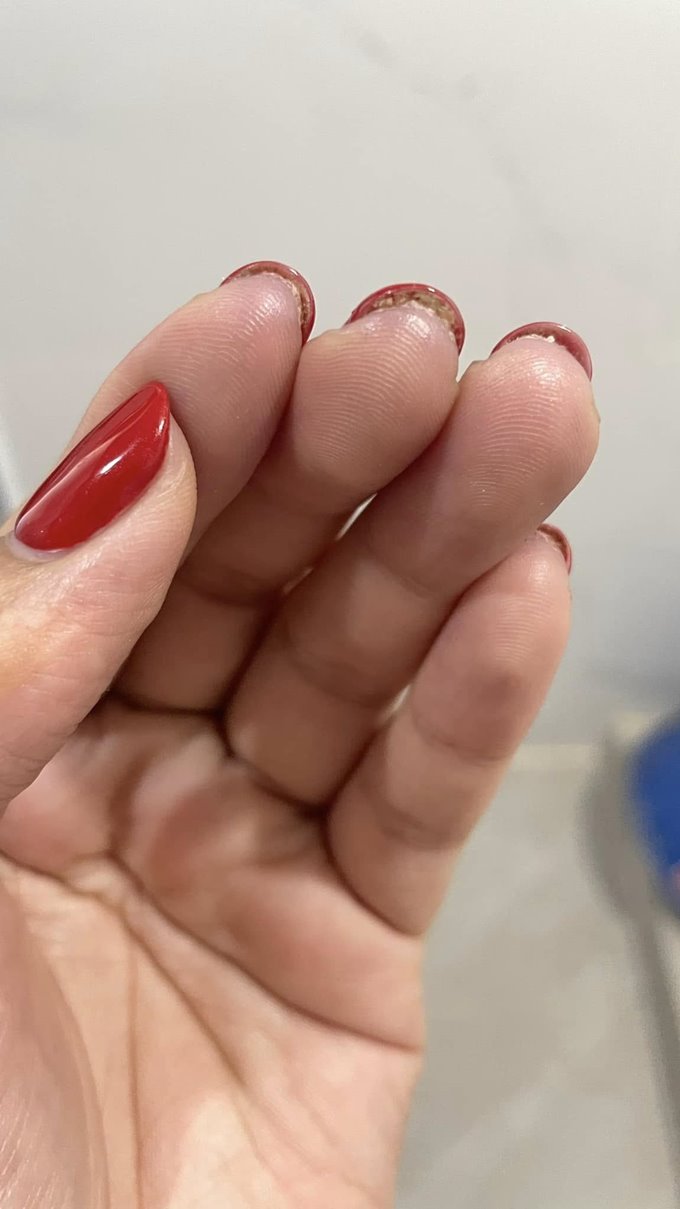 เตือนภัยคนชอบทำเล็บเจล เล็บติดเชื้อ แต่ร้านกลับเสนอทำฟรีอีก 1 เดือน