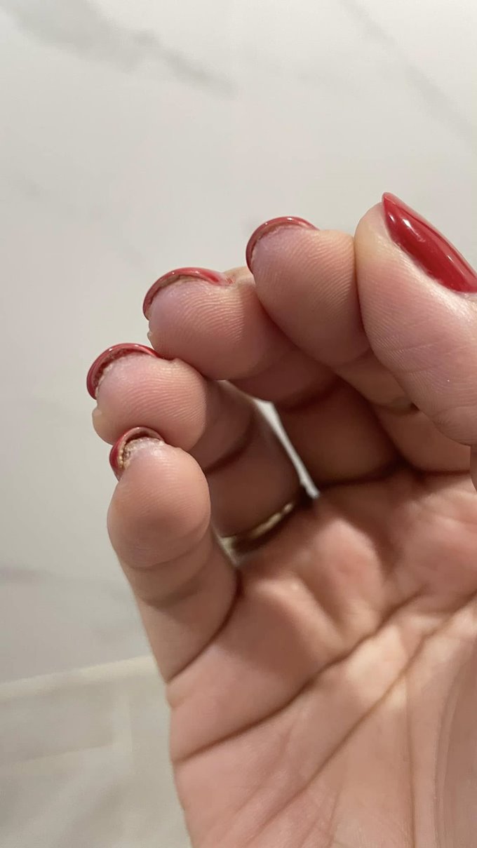 เตือนภัยคนชอบทำเล็บเจล เล็บติดเชื้อ แต่ร้านกลับเสนอทำฟรีอีก 1 เดือน