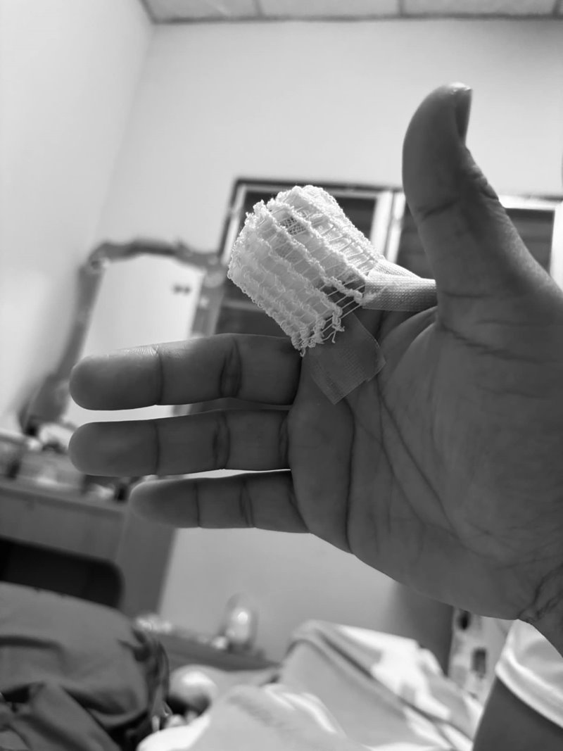 นักดนตรีเสียนิ้ว หลังถูกถังปั่นผ้าดูด เจ็บหนักจนต้องตัดนิ้ว