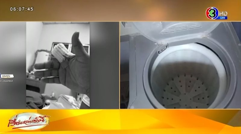 นักดนตรีเสียนิ้ว หลังถูกถังปั่นผ้าดูด เจ็บหนักจนต้องตัดนิ้ว