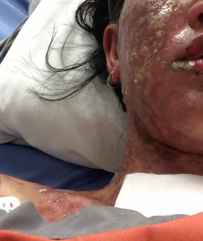 สาวแพ้ยาแก้ปวด แพ้ยารุนแรง นอน ICU 36 วัน ตอนนี้ยังไม่หายดี