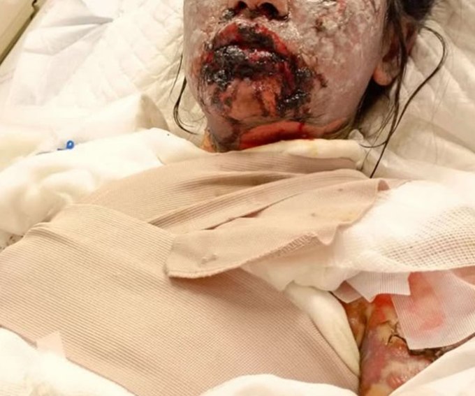 สาวแพ้ยาแก้ปวด แพ้ยารุนแรง นอน ICU 36 วัน ตอนนี้ยังไม่หายดี