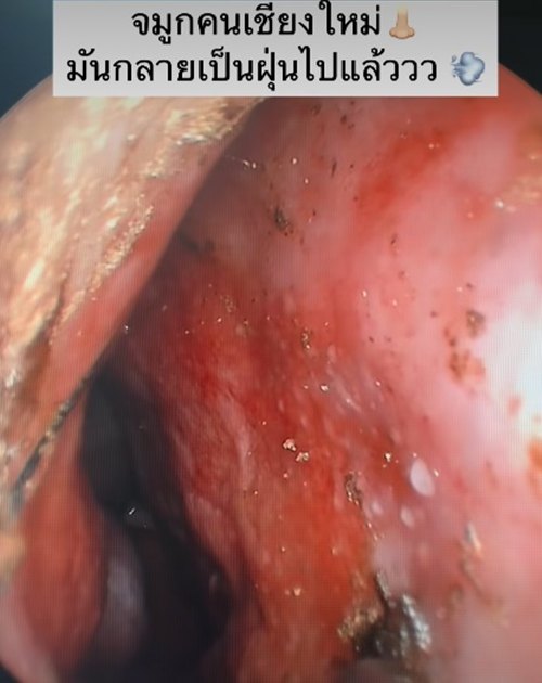 เปิดสภาพภายในจมูกคนไข้ หลังรับฝุ่น PM2.5 ปอดจะขนาดไหน
