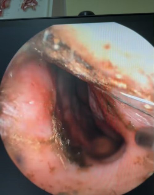 เปิดสภาพภายในจมูกคนไข้ หลังรับฝุ่น PM2.5 ปอดจะขนาดไหน