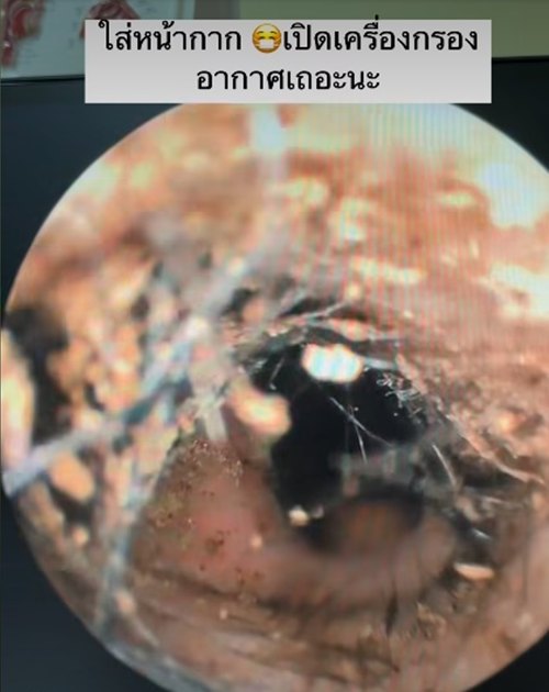 เปิดสภาพภายในจมูกคนไข้ หลังรับฝุ่น PM2.5 ปอดจะขนาดไหน