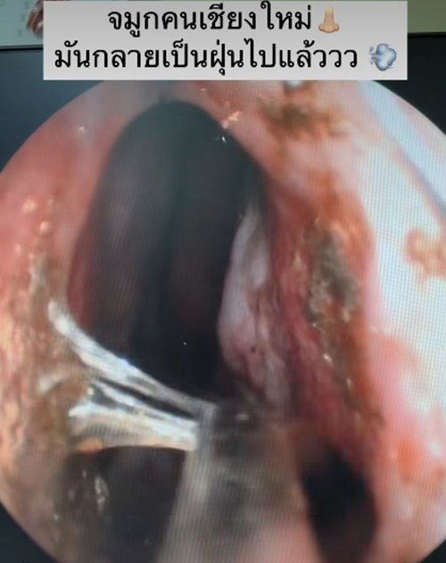 เปิดสภาพภายในจมูกคนไข้ หลังรับฝุ่น PM2.5 ปอดจะขนาดไหน