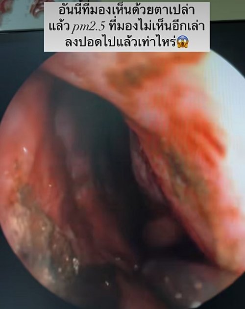 เปิดสภาพภายในจมูกคนไข้ หลังรับฝุ่น PM2.5 ปอดจะขนาดไหน