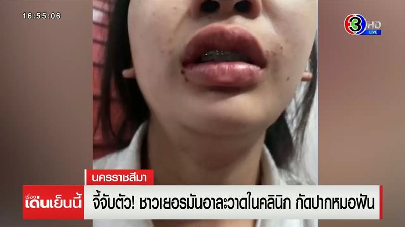 ฝรั่งคลั่ง ตระเวนอาละวาด ทำร้ายหมอฟัน ซ้ำคดีไม่คืบ