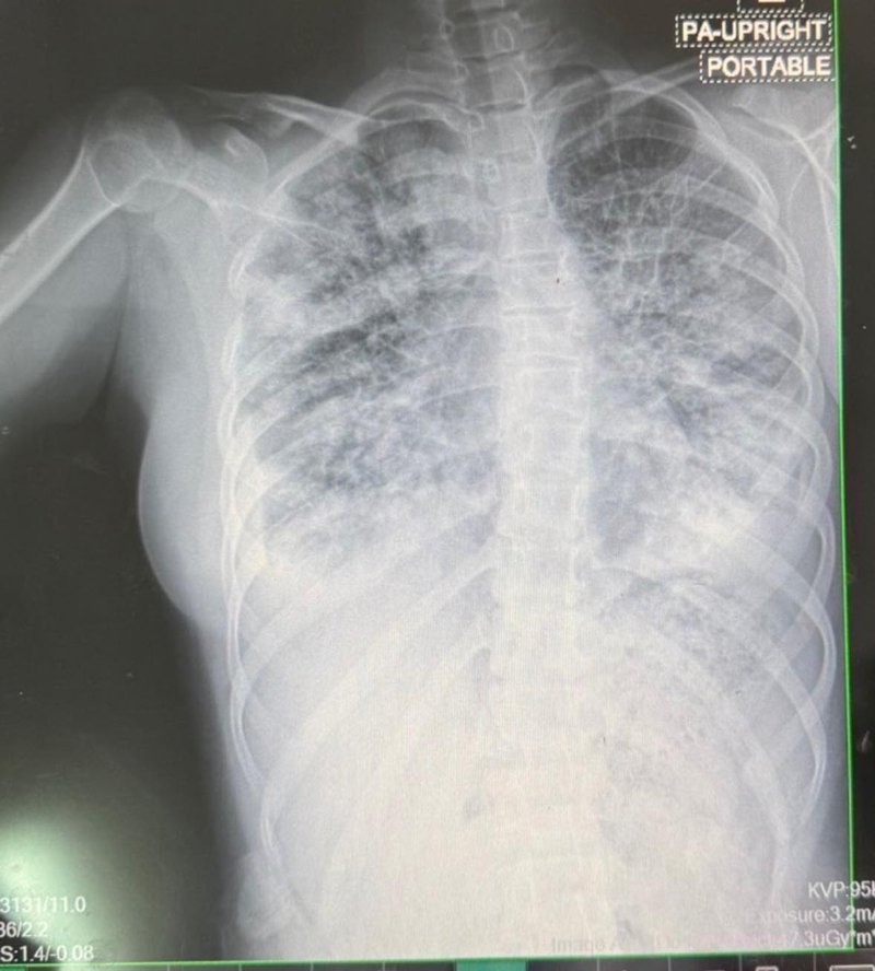 ช็อก เปิดภาพปอดเด็ก 14 หลังสูบบุหรี่ไฟฟ้า 1 ปี