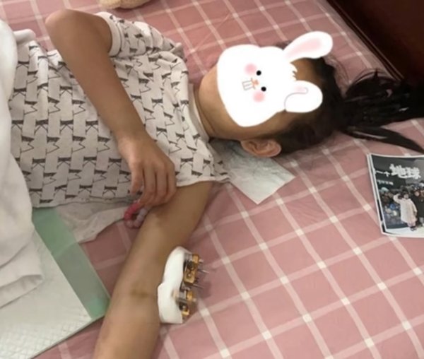 เด็กหญิง 9 ขวบรอดชีวิต หลังตกตึกชั้น 25 บาดเจ็บแค่กระดูกหัก