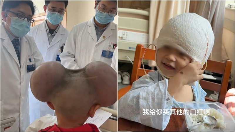 เด็ก 3 ขวบ มีไฝยักษ์ ถูกล้อเหมือนมิกกี้เมาส์ ตอนนี้ยิ้มได้ หลังผ่าตัดแล้ว