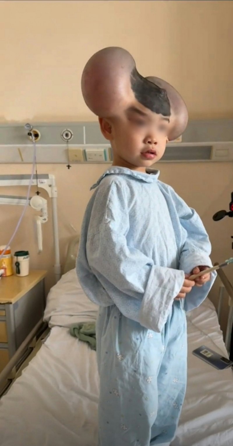 เด็ก 3 ขวบ มีไฝยักษ์ ถูกล้อเหมือนมิกกี้เมาส์ ตอนนี้ยิ้มได้ หลังผ่าตัดแล้ว