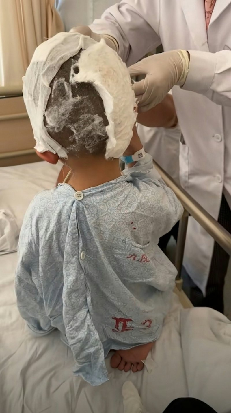 เด็ก 3 ขวบ มีไฝยักษ์ ถูกล้อเหมือนมิกกี้เมาส์ ตอนนี้ยิ้มได้ หลังผ่าตัดแล้ว