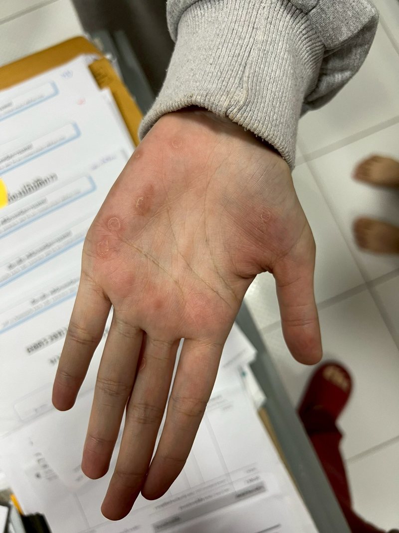 คนวิเคราะห์ ทำไม ซิฟิลิส กับ HIV ระบาดหนักมาก ที่มหาสารคาม