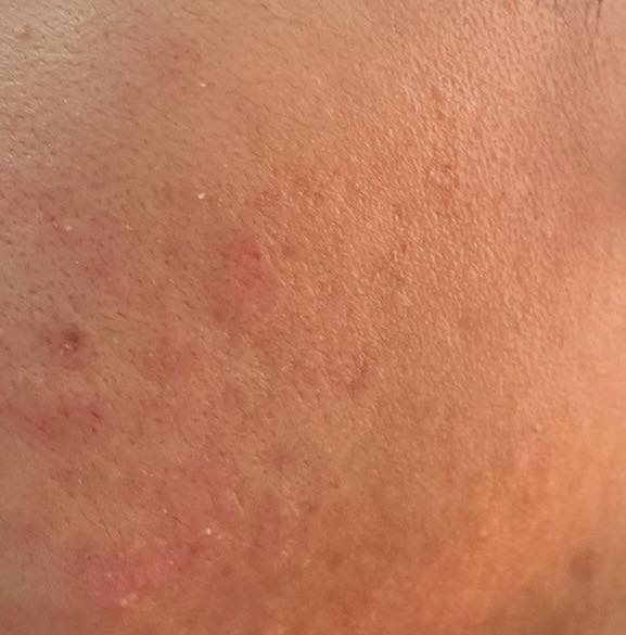 คนวิเคราะห์ ทำไม ซิฟิลิส กับ HIV ระบาดหนักมาก ที่มหาสารคาม