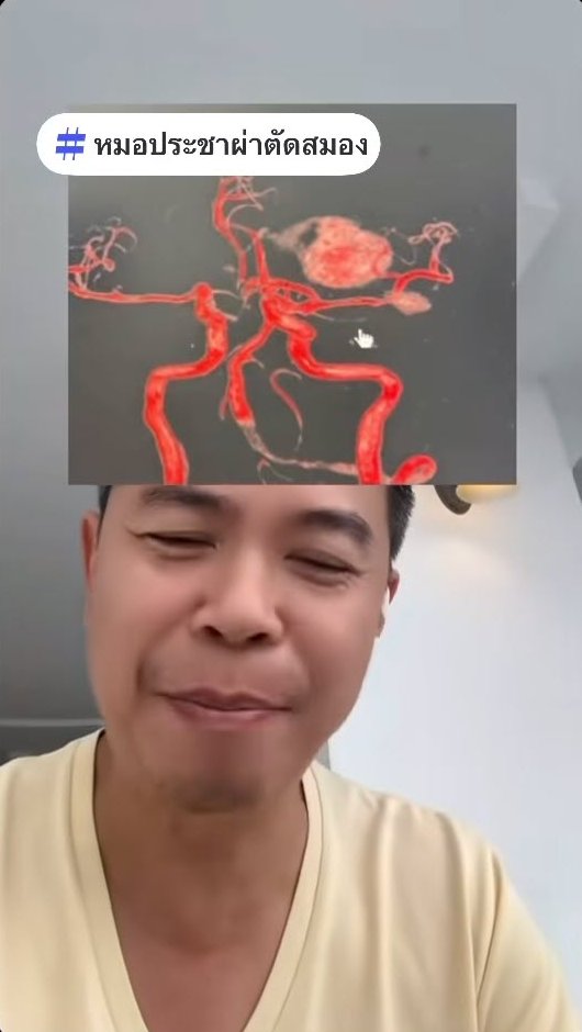 หมอประชาเตือน คนเป็นความดัน ดื่มกาแฟตอนเช้าตรู่ เสี่ยงเส้นเลือดสมองแตก