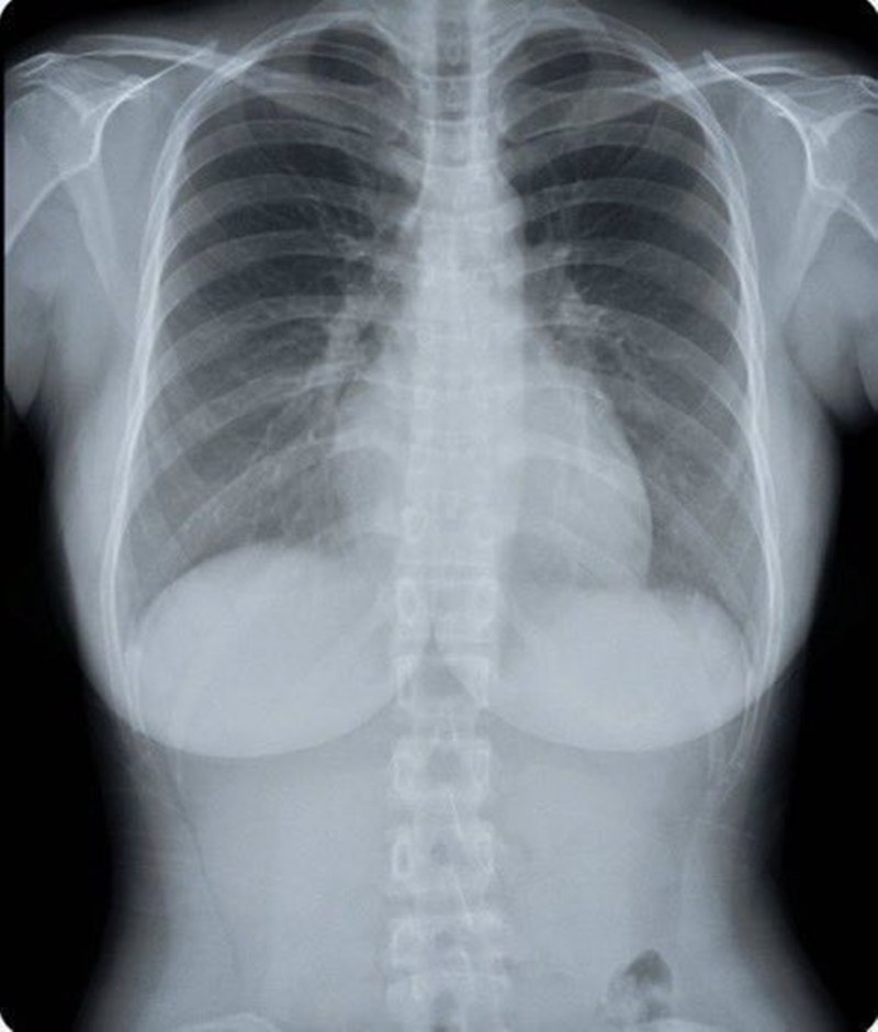 สาวโพสต์ภาพ X-Ray เต้านม ทำคนหลุดโฟกัส กลายเป็นประเด็นร้อน