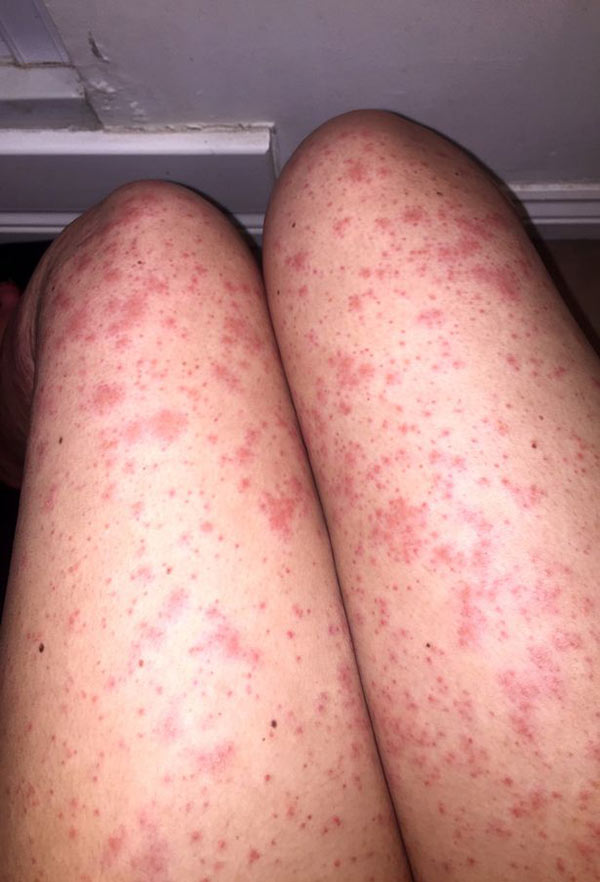 สาวเห็นผื่นขึ้นเต็มขา นึกว่าโกนขนแล้วแพ้ แต่กลับต้องช็อกเมื่อพบความจริง 