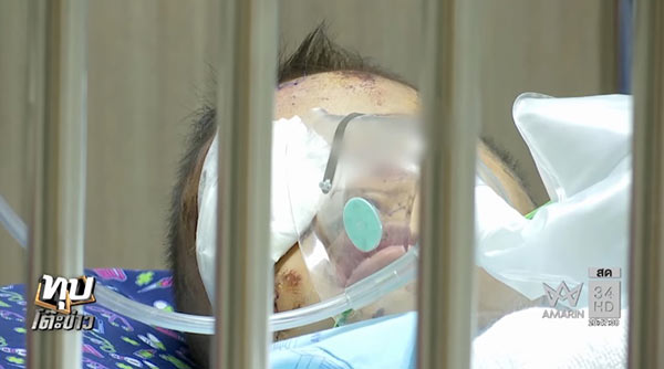 น้องน้ำ ถูกสุนัขจรจัดรุมกัด