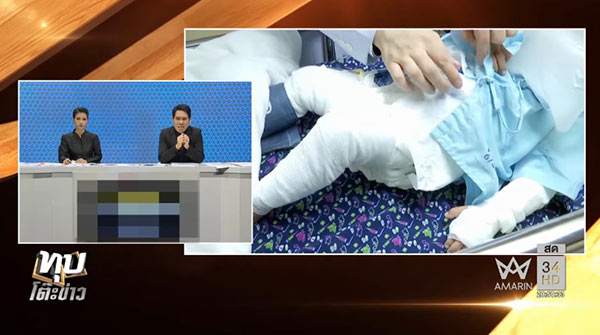 น้องน้ำ ถูกสุนัขจรจัดรุมกัด