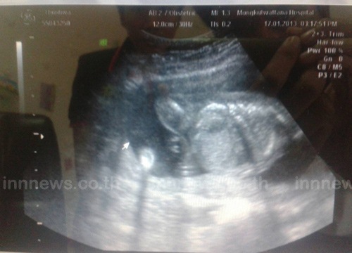 เด็ก4ขา 2 เพศ ปทุมธานี