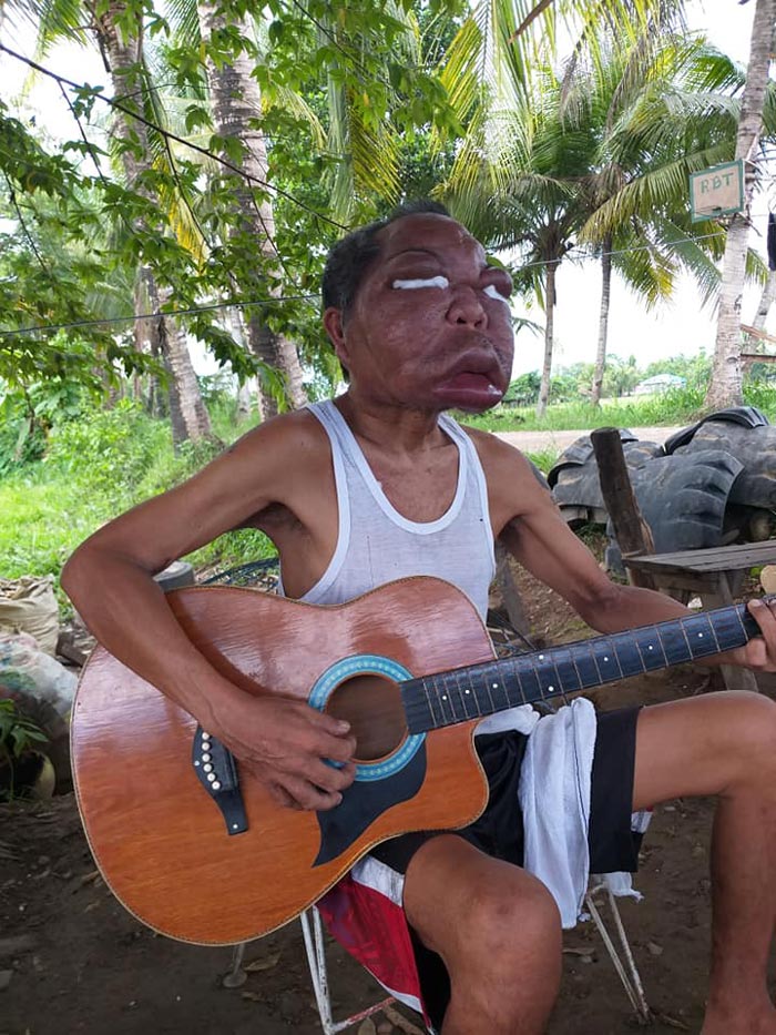 ลุงป่วยหน้าบวม