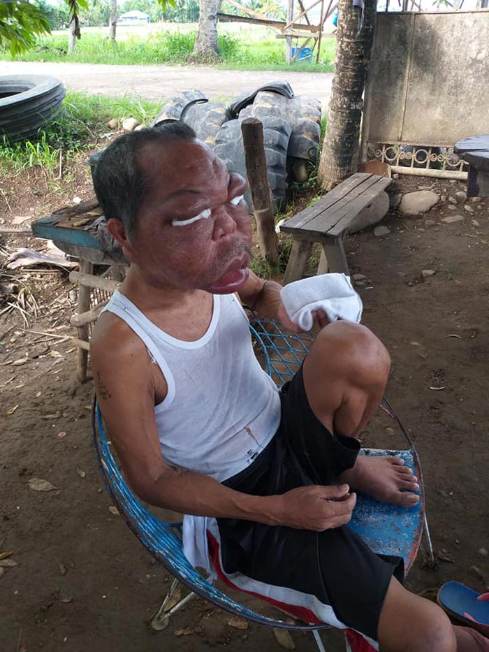 ลุงป่วยหน้าบวม