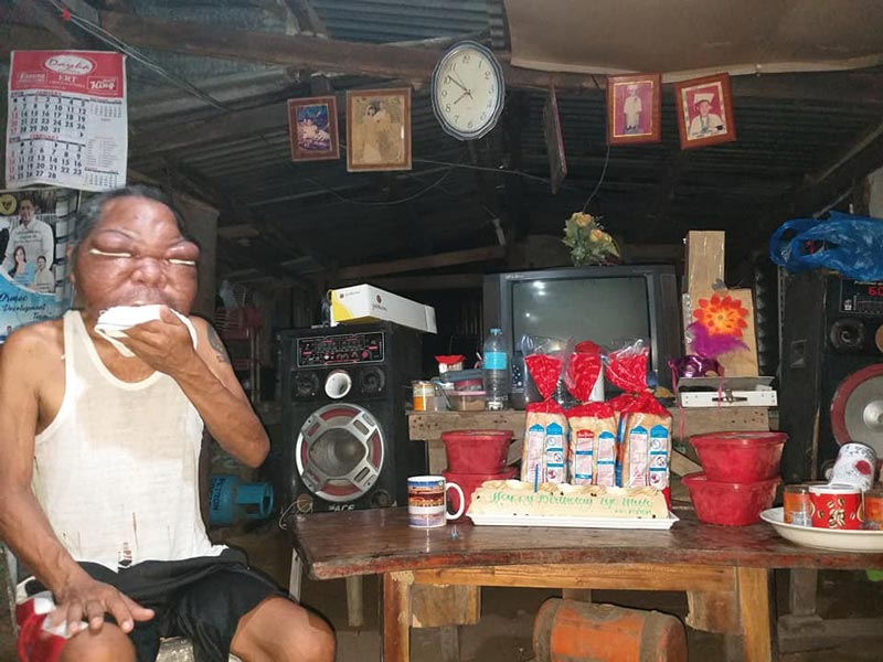 ลุงป่วยหน้าบวม