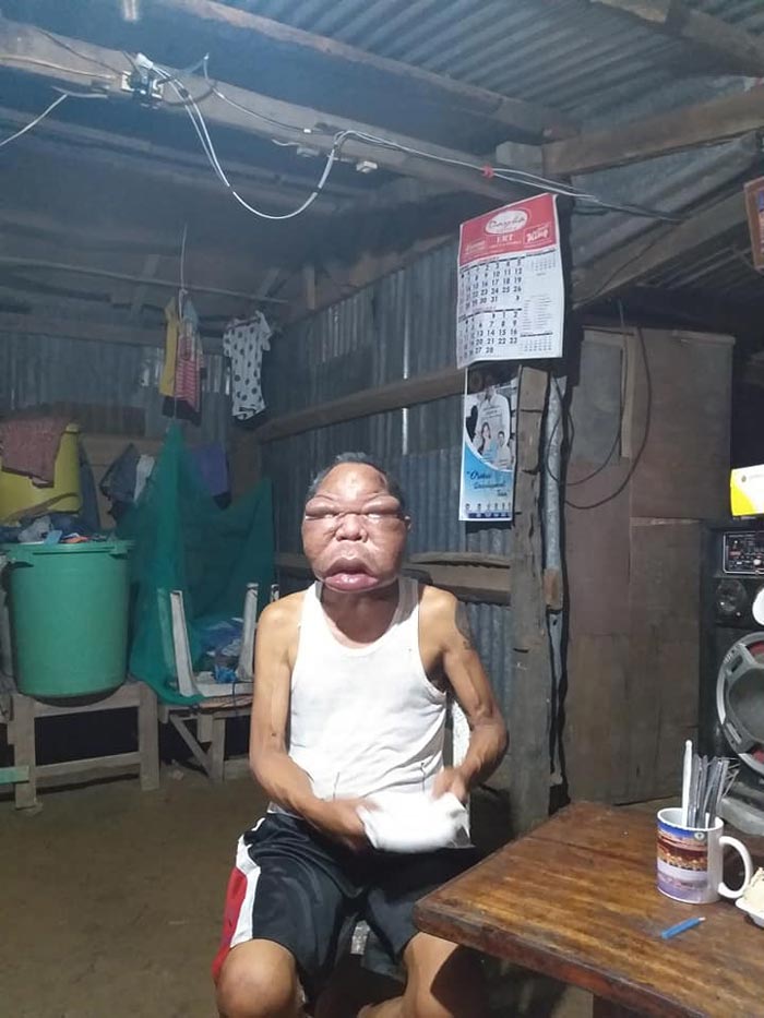 ลุงป่วยหน้าบวม