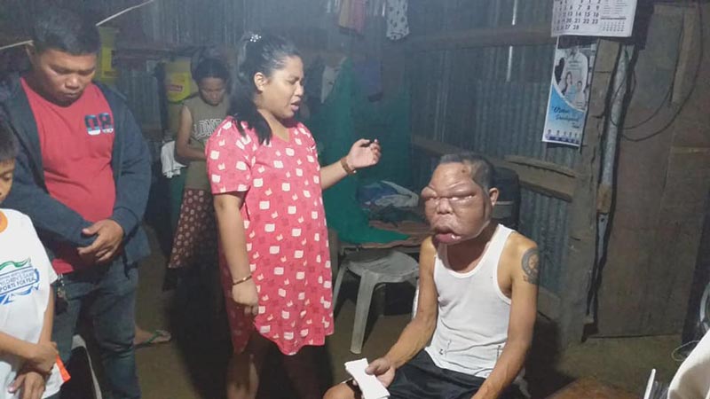 ลุงป่วยหน้าบวม