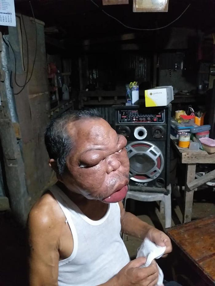 ลุงป่วยหน้าบวม