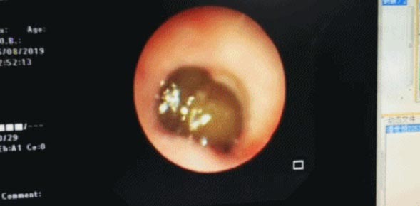 ปลิงติดหลอดลม