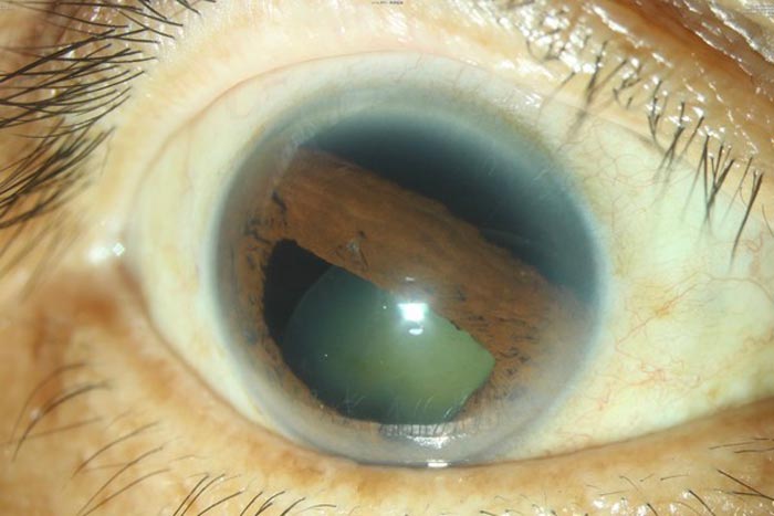 ลูกแบดกระแทกตา