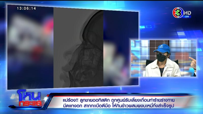 ร้องศูนย์รับเลี้ยงเด็ก ทำร้ายเด็กออทิสติก