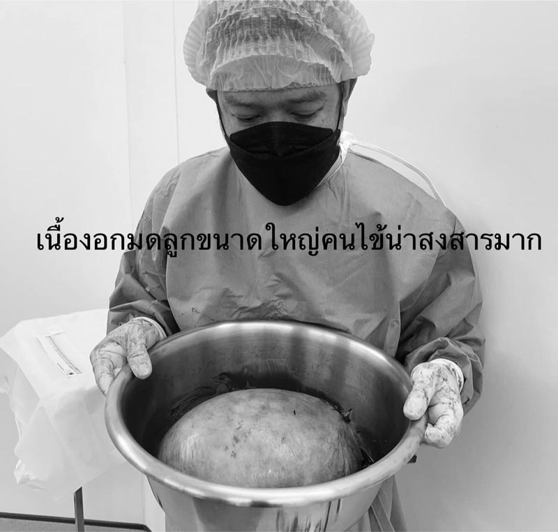เนื้องอกในมดลูก