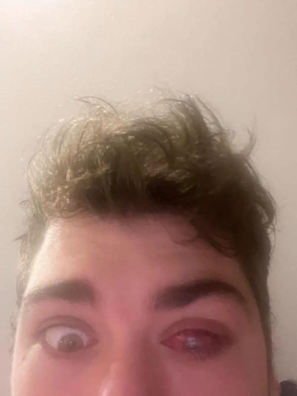 ใส่คอนแทคเลนส์นอน ตาอักเสบ