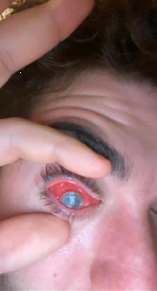 ใส่คอนแทคเลนส์นอน ตาอักเสบ