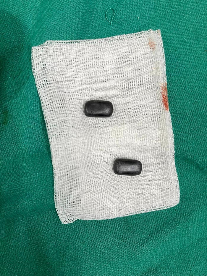 ฝังแม่เหล็กที่นิ้วมือ